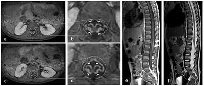 Case report: Incidence and prognostic value of brain MRI lesions and elevated cerebrospinal fluid protein in children with Guillain-Barré syndrome